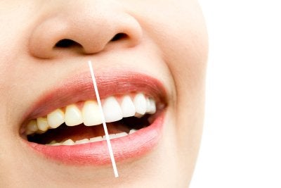 teeth - whitening